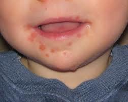 pied main bouche contagion garderie pied main bouche contagion garderie
