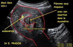Fibrome sous muqueux / Dr Eric PRADOS/ Med-sein  / AFMGOS