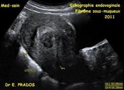 Fibrome sous muqueux / échographie / Dr e. Prados / Med-sein / AFMGOS